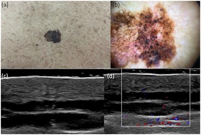 Preoperative bimodal imaging evaluation in finding histological correlations of in situ, superficial spreading and nodular melanoma